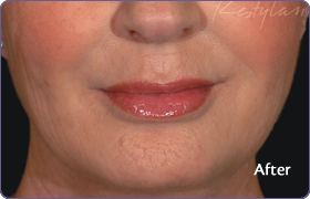 After-Nasolabial folds treatment with RESTYLANE
