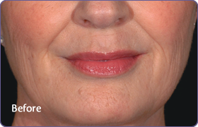 Before-Nasolabial folds treatment with RESTYLANE