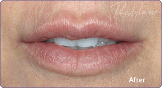After-Lip enhancement with RESTYLANE