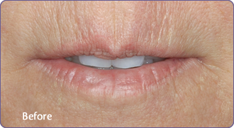 Before-Lip enhancement with RESTYLANE
