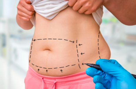 A woman getting drawings on body by doctor for liposuction procedure